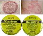 2 x Nixoderm Cream 20g For Skin Problems Eczema Ringworm Blemishes & Pimples