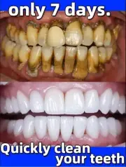 Original Remover Dental Calculus Whitening Teeth Mouth Odor Bad Breath Prevent