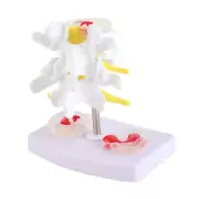 Anatomical Lumbar Disc Herniation Model Human Spine For Teaching KRI