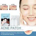 Pimple Patches Acne Spot Treatment Hydrocolloid Master Skin Tag Remover Patch