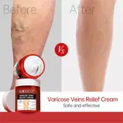 Removal Varicose Veins Treatment Cream Anti Spider Stretch Marks Vasculitis HOTけ