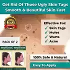2X NEW SKIN TAG REMOVER CREAM SAFE FAST WART REMOVAL MOLE ACNE PIMPLE PATCH SPOT