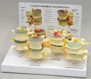 Lumbar Vertebrae Set, Herniated,Anatomical Model, Spine