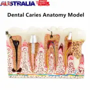 Dental Caries Anatomy Tooth Model Tooth Decay Anatomy Model Teeth Model Demonstr