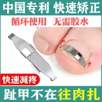 在飛比找蝦皮購物優惠-甲溝炎神器指甲矯正器嵌甲正甲扣貼片腳趾甲長肉裡專用糾正腳溝炎