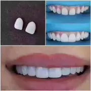 3Pcs No.11# Teeth Veneer Dental Veneers Tooth Whitening Ceramic Bright White LMS