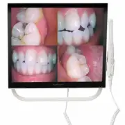 1 Set Dental Monitor Intraora Camera System with Armored Glass (YFHD-D) 17Inch