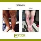 Psoriasis: Remove scaly hardened skin back to naturally beautiful skin