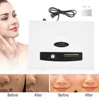 Ultrasonic Freckle Removal Machine Skin Mole Dark Spot Face Wart Tag Remover UK