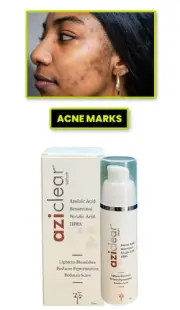 Aziclear Serum – Lightens Blemishes, Reduces Pigmentation and Scars 30ml