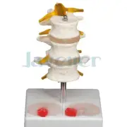 Human Three Lumbar Lesions Intervertebral Disc Skeleton Spine Education Model