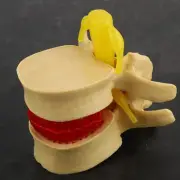 1:1.5 Lumbar Disc Herniation Demonstration Model Study Learn Human Spine WTD