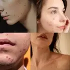 ANTI- SKIN TAG REMOVER ACNE PIMPLE PATCH REMOVAL FACIAL CARE SPOT