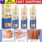 1-3Pcs Bee Venom Psoriasis Care Spray pro Anti-itching Psoriasis Treatment Spray