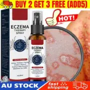 30ML Skin Care Spray Relieves Itchy Skin Itching Repair Skin Psoriasis Spray AU!