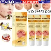 1/2/3/4/5PCS Tag Recede Bee Venom Treatment Cream Skin Tag Remover Skin Care
