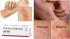 Coal Tar,Salicylic Acid & Sulphur Ointment (15gm) Best for Skin Care