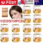 1-10PCS Bee Venom Wart and Tag Remover Bee Venom Mole & Wart TreatmentCream 30g