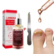 Eficaz Tratamiento Hongos En Las Uñas Antimicotico Para Los Manos Y Pies