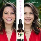 Organic Acne LIQUID Tincture FAST PIMPLE PATCH REMOVAL SPOT SKIN TAG REMOVER OIL