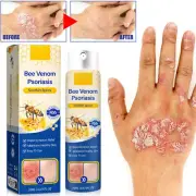 5PCS Psoriasis Treatment Spray Psoriasis Care Spray Bee Venom Pro Anti-itching