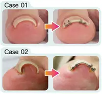 在飛比找露天拍賣優惠-分趾器日本嵌甲矯正器甲溝炎正甲扣腳趾甲卷甲指甲長肉里修糾正神