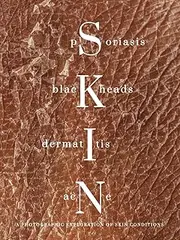 SKIN psoriasis blackheads dermatitis acne: A photographic exploration of skin conditions