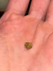kidney stone “bit crushed” passed on 6-20-15 5:15am