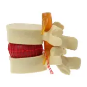 Anatomical Spine Lumbar Disc Herniation Anatomy Teaching Tool Medical propsmodel