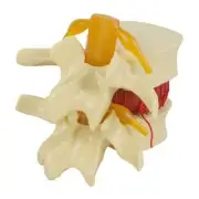 PVC Spine Model 1.5x Scale for Lumbar Disc Herniation Medical Education