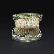 1pc Transparent Dental Model Adult Pathological and Disease Oral Teaching Model Removable for Patient Communication Study Tool