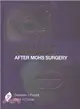 Aesthetic Facial Reconstruction After Mohs Surgery