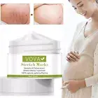 Pregnancy Scar, Spots Acne Scar, Stretch Marks Removal Cream Clarifying Skin