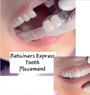 Retainers With Teeth, Affordable Way To Fill In Your Smile, with 1-3 Teeth added