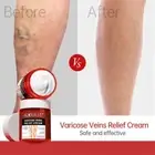 ﹑Removal Varicose Veins Treatment Cream Anti-Spider Stretch Marks Vasculitis