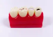 Dental Pit Fissure Caries Sealant Study Model Silver Amalgam Teach Study*1Pcs