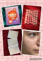 KEYCONCEPTS Pimple Patch 1 PK Pack 120 Hydrocolloid Acne Patches Tea Tree Oil