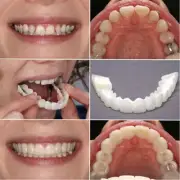 Snap On Bottom/Upper Lower False Teeth Dental Veneers Dentures Fake Tooth Smile