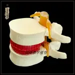 腰椎放大 腰椎間盤受壓 演示模型 人體脊柱 脊椎骨 病理演示模型