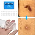 30Pcs Skin Tag Mole Wart Removal Rubber Bands Micro Band Non Toxic Face Care