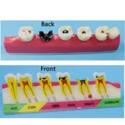 Dental Caries Classify Model Teeth Caries Evolution Decayed Tooth Analysis Model