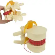 1.5x Spine Model PVC For Lumbar Disc Herniation Educational Tool