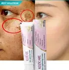 Strong Removal Melasma Whitening Cream Sunburn Spots Pigment Freckle Speckle