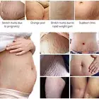 30ml Stretch Mark Cream For Pregnancy Stretch Mark Scar Cream Postpartum Obe Blw
