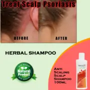 Anti Scaling Scalp Shampoo 100ml - Psoriasis Scalp & Dandruff Treatment