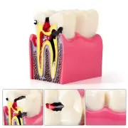 6 Times Dental Caries Tooth Model Decay Teeth Comparative Study Model Teaching