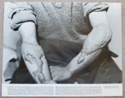 11x14 Photo Japanese Victim of Nuclear Atomic Bombing with Keloid Scars on Arms