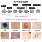 Laser Freckle Removal Machine Skin Mole Dark Spot Face Wart Tag Remover Pen AUS.