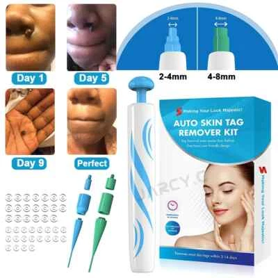 Hot Skin Tag Remover Tool Kit Wart Spot Remover Mole Remover Skin Care Band New