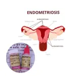 順勢療法的 ENDOMETRIOSIS & ADENOMIOSIS